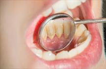 4 cách loại bỏ cao răng tại nhà