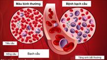 7 dấu hiện cảnh báo bệnh ung thư máu