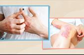 Thuốc điều trị bệnh vảy nến ở phụ nữ