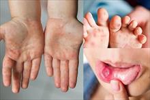 Gia tăng ca mắc tay chân miệng, dấu hiệu cha mẹ cần lưu ý