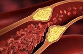 Bí quyết cải thiện xơ vữa động mạch