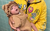 Trẻ sơ sinh 5 ngày tuổi bị thủng dạ dày vì mẹ cho ăn cơm: Cảnh báo sai lầm chết người khi chăm con nhỏ