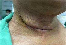 Phát hiện mắc cùng lúc 2 loại ung thư sau 6 tháng khàn tiếng