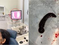 Hãi hùng con đỉa 6cm sống trong mũi cụ bà suốt 3 tuần