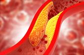 5 lưu ý giúp ngăn ngừa cholesterol cao và phòng tránh đột quỵ