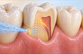 Hợp tác Việt – Hàn nghiên cứu tìm giải pháp cho răng ê buốt