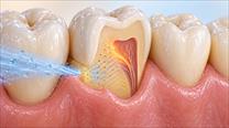 Hợp tác Việt – Hàn nghiên cứu tìm giải pháp cho răng ê buốt