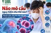 Não mô cầu nguy hiểm như thế nào? Nguyên nhân, dấu hiệu nhận biết sớm và cách phòng ngừa