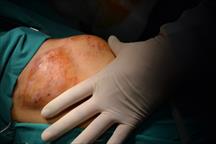 Bóc khối u mỡ to bằng quả bưởi ở ngực một bệnh nhân nam