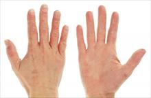 10 dấu hiệu trên đôi tay tố cáo tình trạng sức khỏe