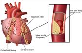 Viêm cơ tim có nguy hiểm không, biểu hiện của viêm cơ tim