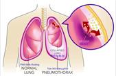 Tràn dịch màng phổi: Nguyên nhân, biểu hiện và điều trị