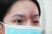 Thiếu nữ 17 tuổi mù mắt sau khi tiêm filler