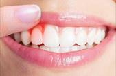 5 cách phòng viêm quanh răng tránh nguy cơ rụng răng