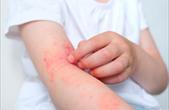 Bài thuốc điều trị viêm da cơ địa