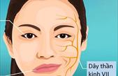 Phòng ngừa liệt dây thần kinh số VII