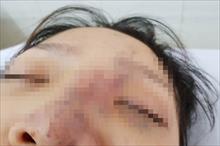Phạt chủ spa tiêm filler khiến nữ sinh viên 20 tuổi mù mắt 35 triệu đồng