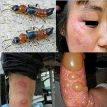 Bệnh viêm da tiếp xúc do côn trùng