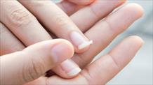 5 dấu hiệu của móng tay báo hiệu sức khỏe của bạn đang không tốt