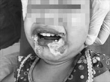 Yên Bái: Bé gái 2 tuổi hoại tử miệng vì cắn phải dây điện