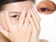Bỏ ngay hai thói quen gây nhiễm khuẩn lên mắt mũi trước khi quá muộn