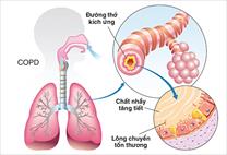 Bệnh phổi tắc nghẽn mạn tính có thể phòng ngừa?