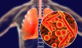 Lao phổi: phải tuân thủ điều trị mới khỏi bệnh