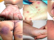 Lâm Đồng: Bùng phát bệnh tay chân miệng ở một trường mầm non