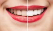 Tẩy trắng có làm ảnh hưởng men răng?