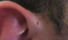 Lỗ nhỏ ở cạnh tai là gì?