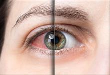 Bệnh khô mắt ở dân văn phòng - Lời khuyên từ chuyên gia