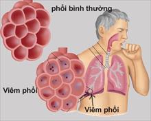 Bộ Y tế hướng dẫn chẩn đoán, điều trị viêm phổi ở người lớn, nhấn mạnh việc tiêm phòng