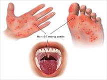 3 dấu hiệu cảnh báo bệnh tay chân miệng ở giai đoạn nặng