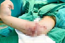 TPHCM: Nối thành công cánh tay bị đứt lìa cho bệnh 8 tuổi