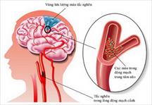 Nguy cơ tai biến mạch máu não do tăng huyết áp