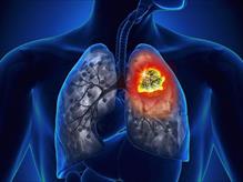 Kết hợp hóa trị và liệu pháp miễn dịch trong điều trị ung thư phổi
