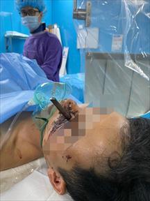Kinh hoàng: Nam thanh niên bị thanh sắt đâm xuyên mặt khi ngã xe