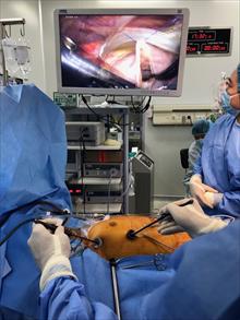 Ứng dụng công nghệ nội soi 3D cắt bỏ khối u lớn trong tim