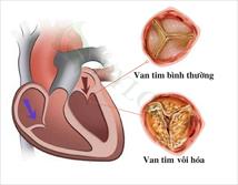 Biến chứng nguy hiểm của vôi hóa van tim