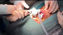 Phẫu thuật nội soi tuyến giáp qua đường miệng: Bước đột phá trong phẫu thuật u tuyến giáp