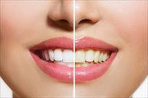Đánh răng mỗi ngày nhưng răng vẫn ố vàng: Nguyên nhân do đâu?