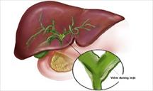 Hạn chế dùng ocaliva ở bệnh nhân viêm đường mật nguyên phát bị xơ gan tiến triển