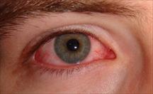 Đỏ và đau nhức mắt dữ dội - Cẩn thận bị viêm củng mạc