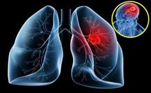 Ung thư phổi: Các phương pháp chẩn đoán