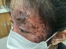 Dùng thuốc trị nấm sai cách, bé gái 8 tuổi bị tổn thương da nghiêm trọng