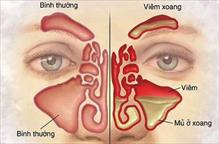 Viêm xoang – Polyp mũi: Các dấu hiệu và cách phân biệt