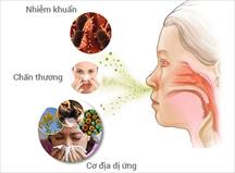 Cách phân biệt viêm xoang và viêm mũi dị ứng