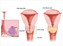 Các phương pháp sàng lọc phát hiện sớm ung thư cổ tử cung