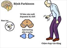 Khuyến cáo mới của Học viện Thần kinh Mỹ về điều trị sớm ở người bệnh Parkinson