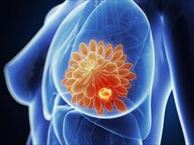 Liệu pháp nội tiết có làm tăng nguy cơ ung thư vú?